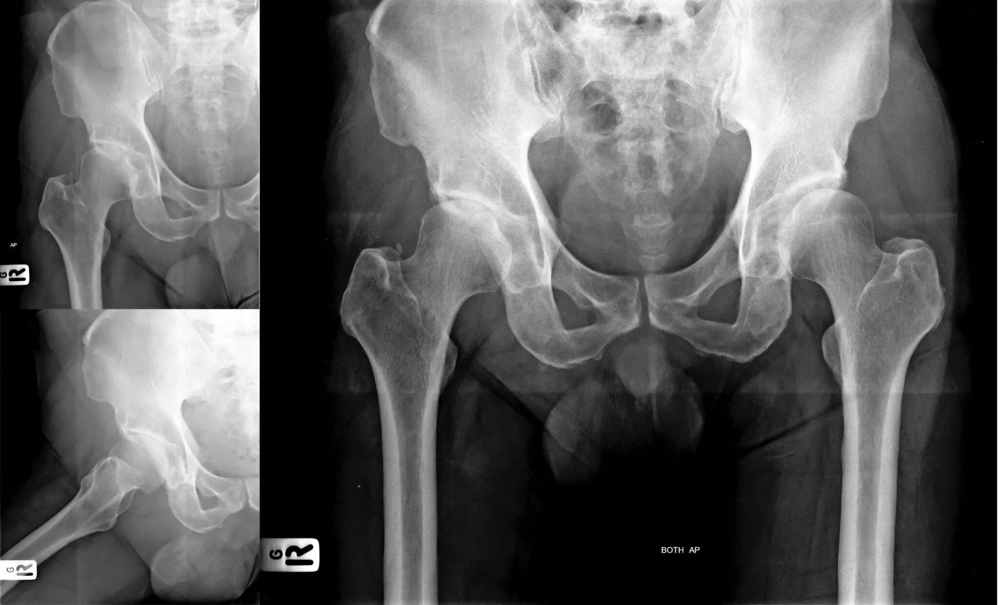 Рентген бедренной кости фото Reconsider Panadol Osteo delisting in light of risks: Painaustralia Low level la