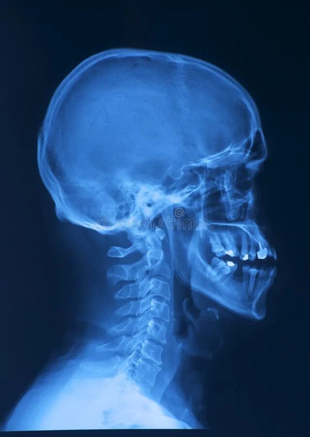 Рентген черепа фото Skull x-ray image stock photo. Image of medical, roentgen - 12941892