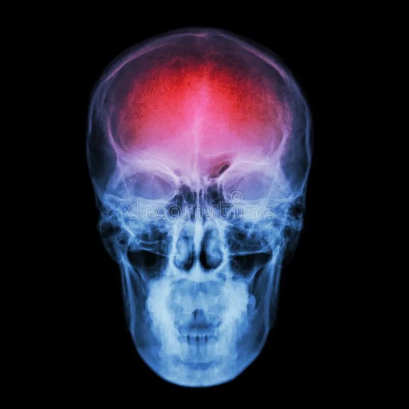 Рентген черепа фото X-ray Skull and Stroke ( Cerebrovascular Accident (CVA) ) Stock Image - Image of