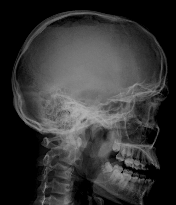 Рентген черепа фото Телерентгенограмма ТРГ в Ярославле
