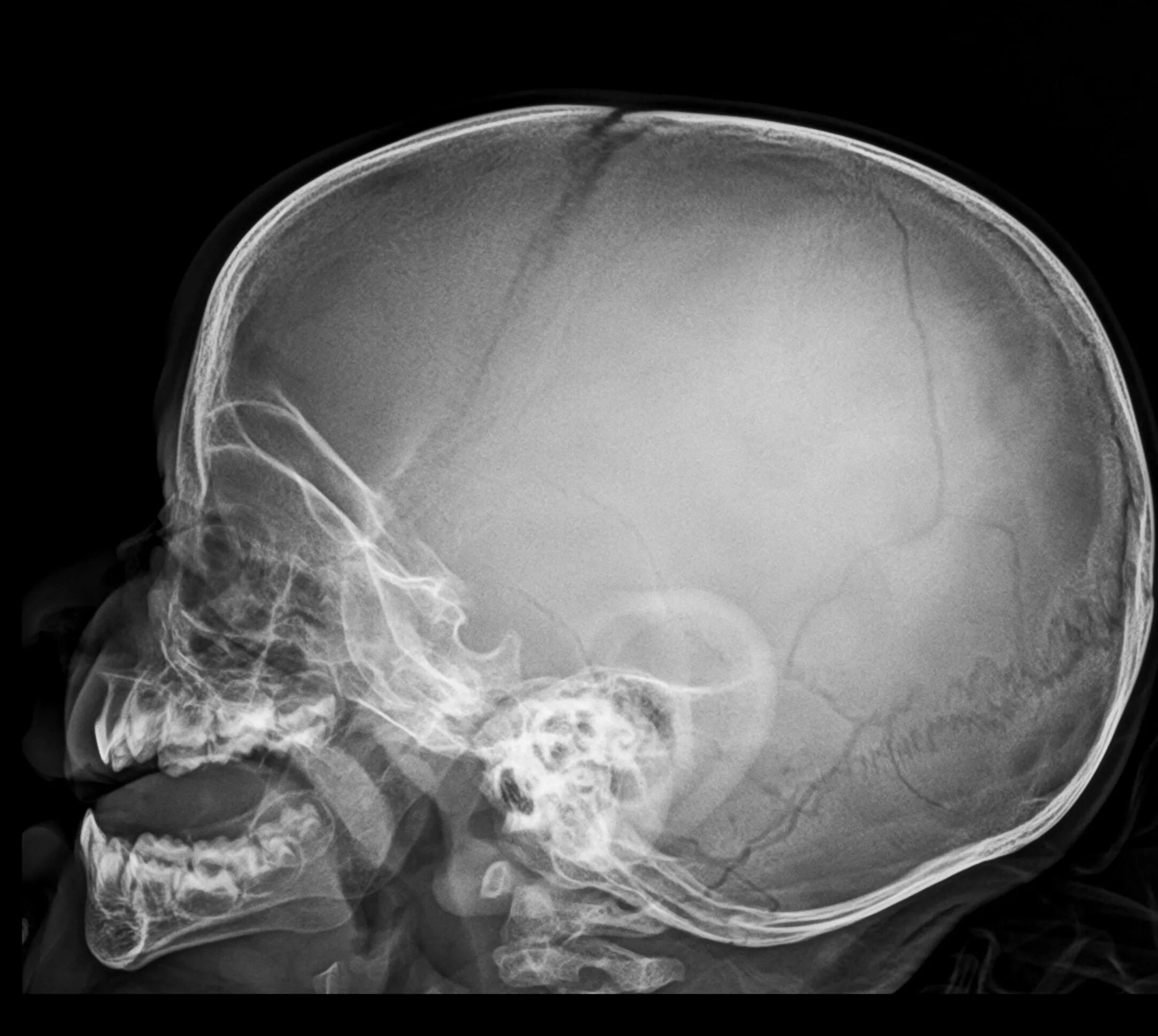 Рентген черепа фото Skull fracture - linear Image Radiopaedia.org