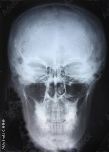 Рентген черепа фото Xray of Skull: comprar esta foto de stock y explorar imágenes similares en Adobe