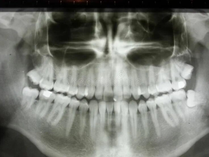 Рентген детских зубов фото Impacted wizdom teeth panoramic xray. Showing all teeth , #AD, #teeth, #wizdom, 