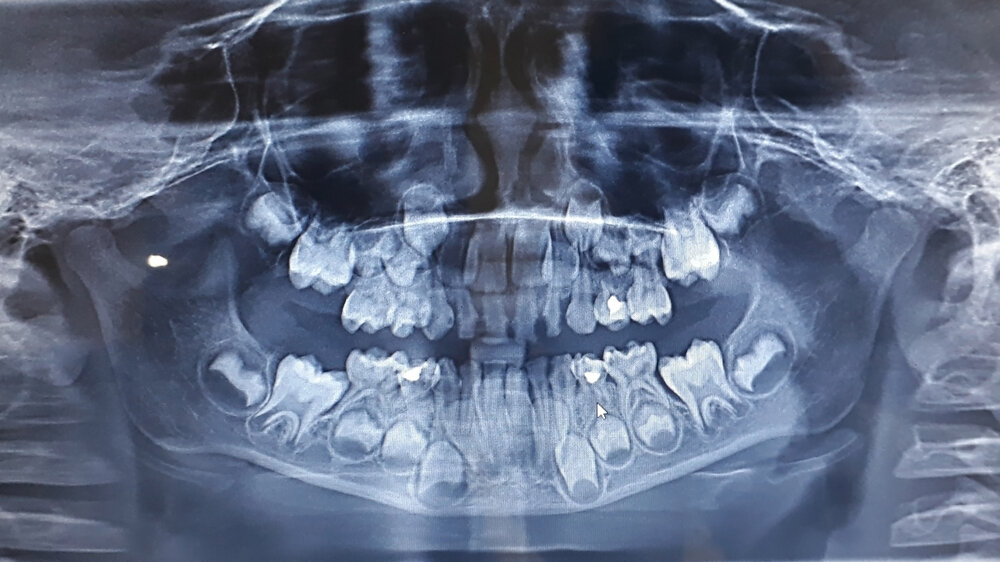Рентген детских зубов фото Рентген зуба на ранних сроках