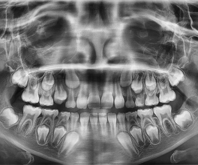 Рентген детских зубов фото Рентген молочных зубов: снимок челюсти ребенка, как часто, со скольки лет можно 