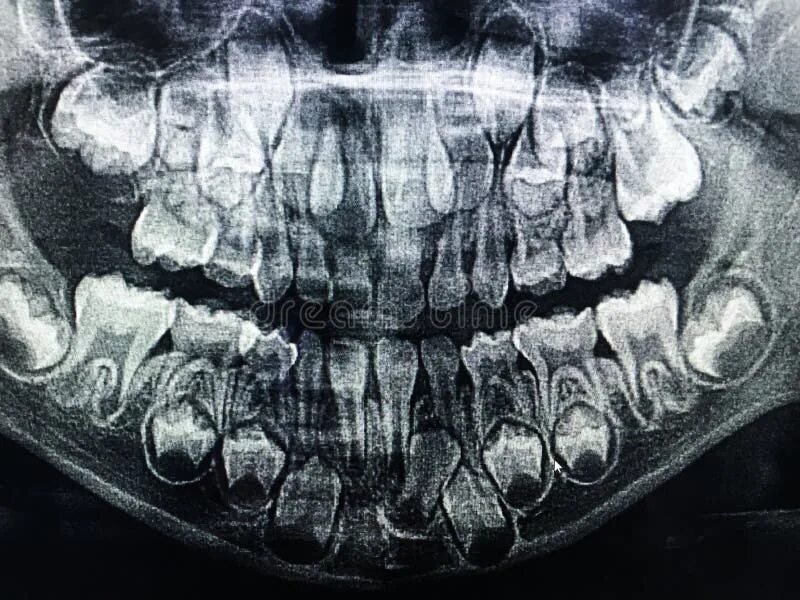 Рентген детских зубов фото Dental X-Ray of Child 6 Years, All Baby Teeth in View. Stock Photo - Image of pa