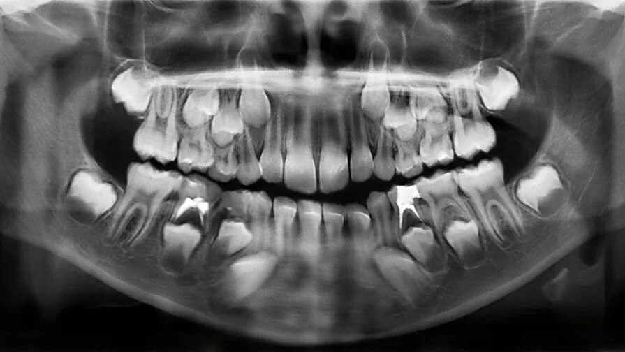 Рентген детских зубов фото Психиатры: болезни психики можно выявить по молочным зубам - Газета.Ru