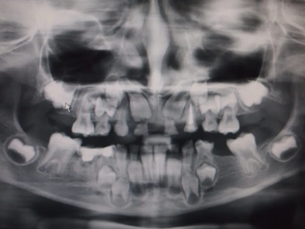Рентген детских зубов фото Новости