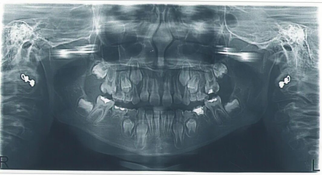 Рентген детских зубов фото Рентгенологическая семиотика заболеваний пародонта у детей - Студопедия