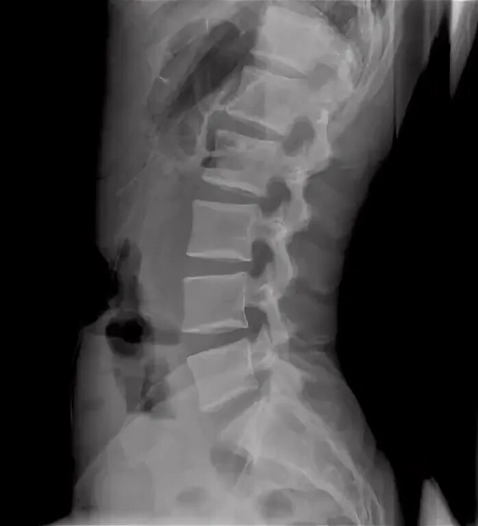 Рентген грудного отдела фото Radiografía de la columna lumbar, perfil Columna lumbar, Lumbares, Columnas