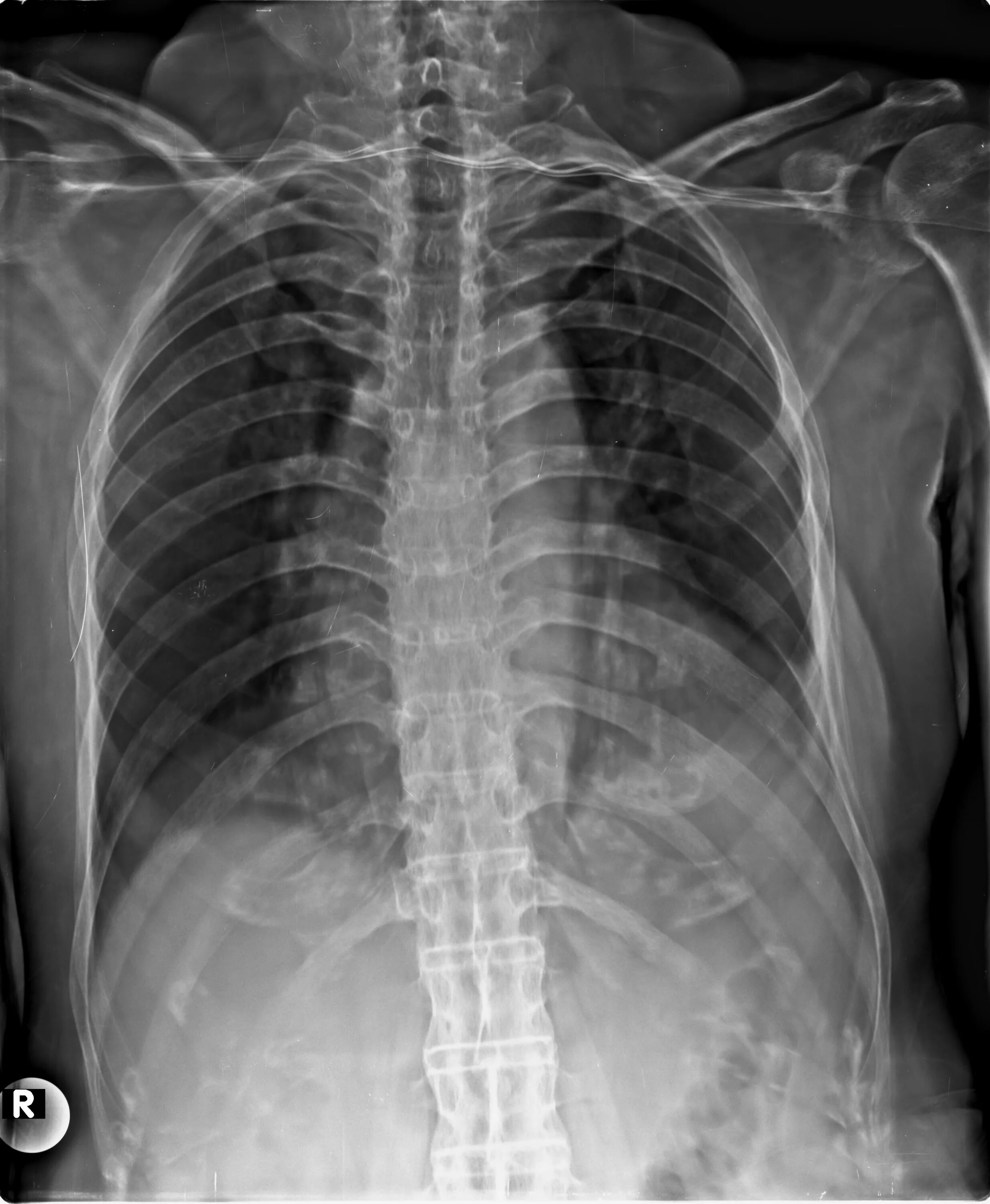 Рентген грудного отдела фото Ankylosing spondylitis Image Radiopaedia.org