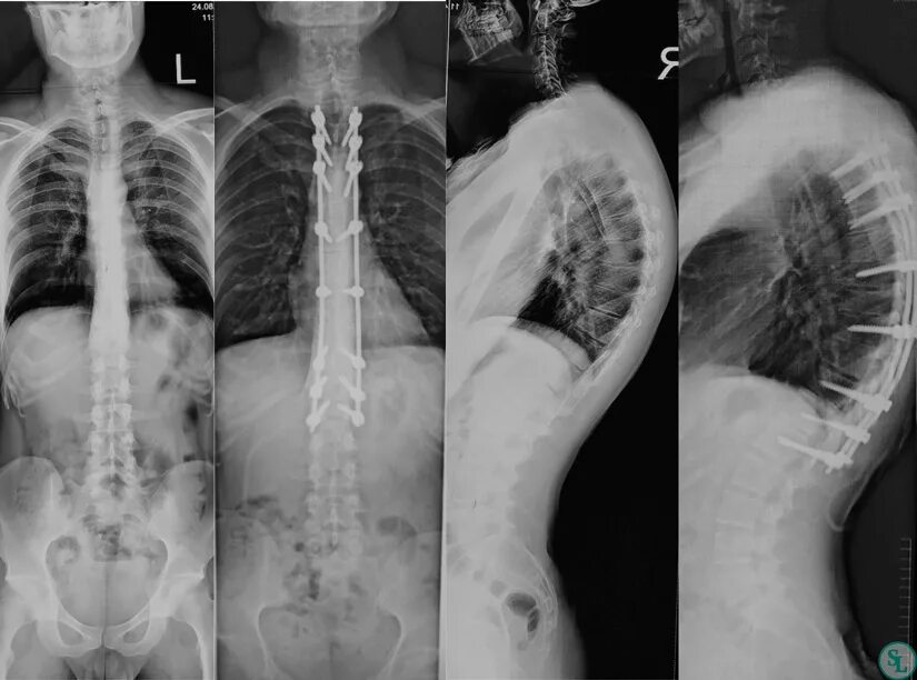 Рентген грудного отдела фото Хирургическое лечение гиперкифоза грудного отдела позвоночкана фоне Б-ни Шейерма