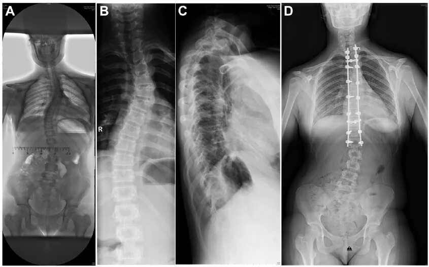 Рентген грудного отдела фото X-ray photographs of the thorax of the patient. A. Severe scoliosis. B.... Downl