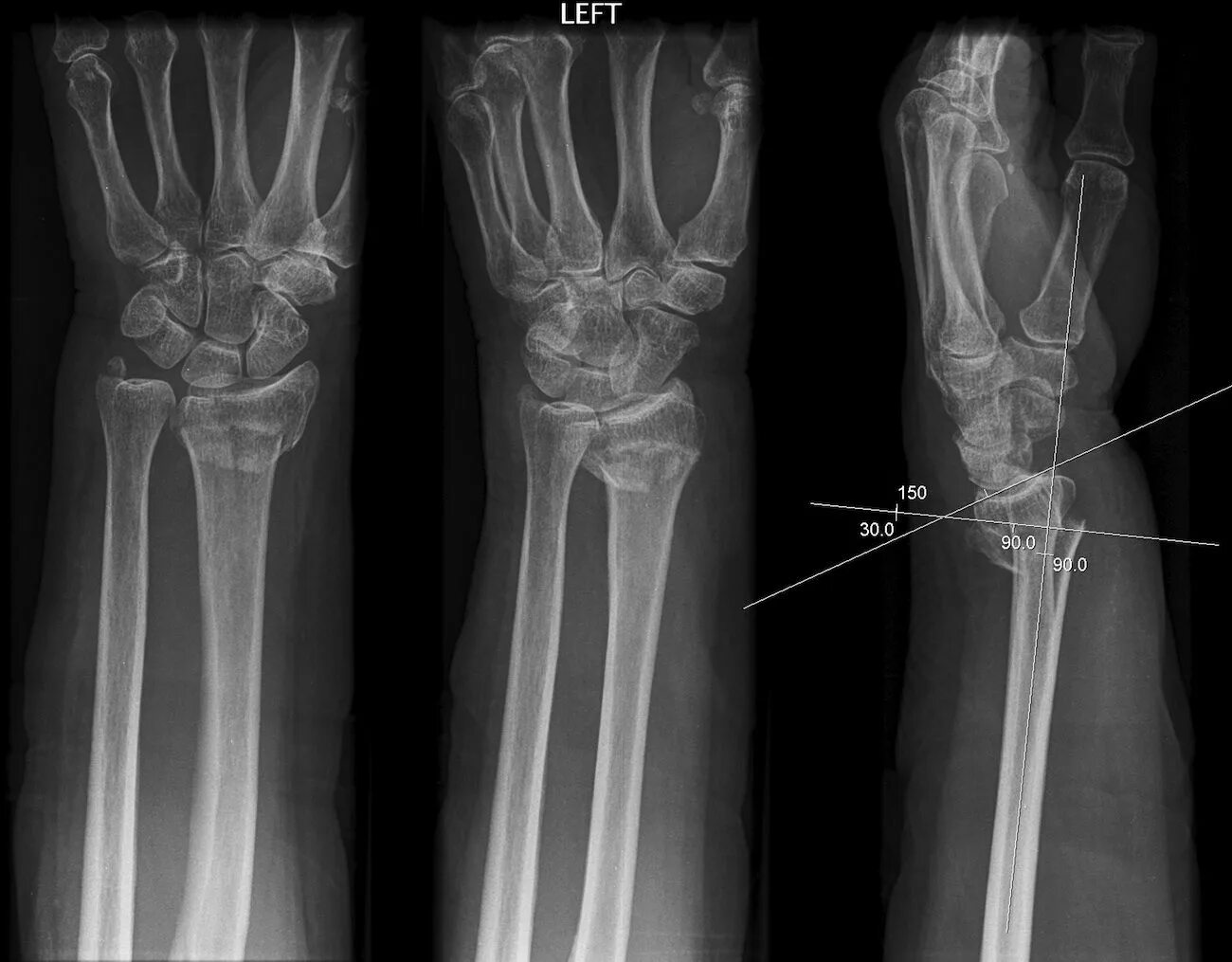 Рентген лучевой кости фото Colles Fx fall on outstretched hand. distal radius fx (with the shown angles) of