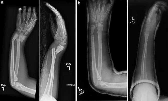 Рентген лучевой кости фото Distal Radius Fractures Obgyn Key