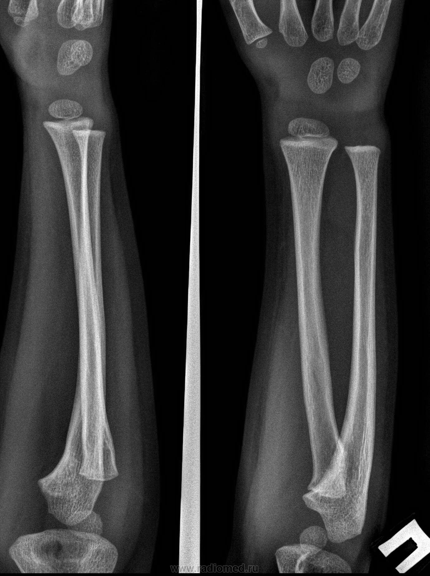 Рентген лучевой кости фото Травма. Портал радиологов
