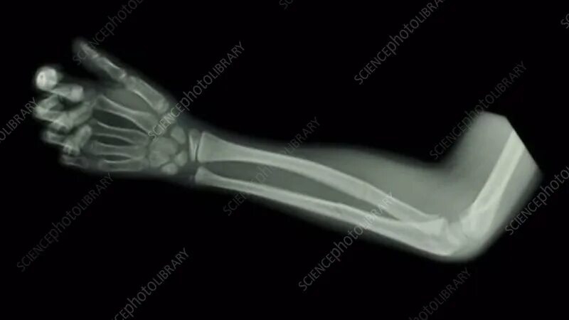 Рентген лучевой кости фото Forearm fracture, X-ray - Stock Video Clip - K005/1267 - Science Photo Library