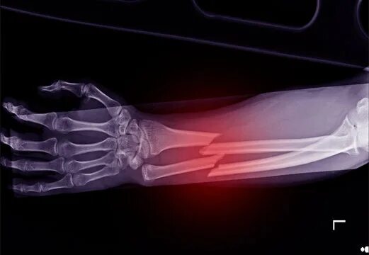 Рентген лучевой кости фото Broken Bone Xray Зображення - огляд 28,617 Стокові фото, векторні зображення й в