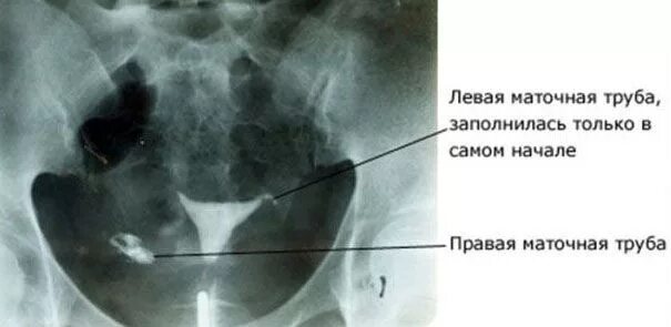 Рентген маточных труб фото Непроходимость маточных труб: симптомы, лечение Операции при непроходимости труб