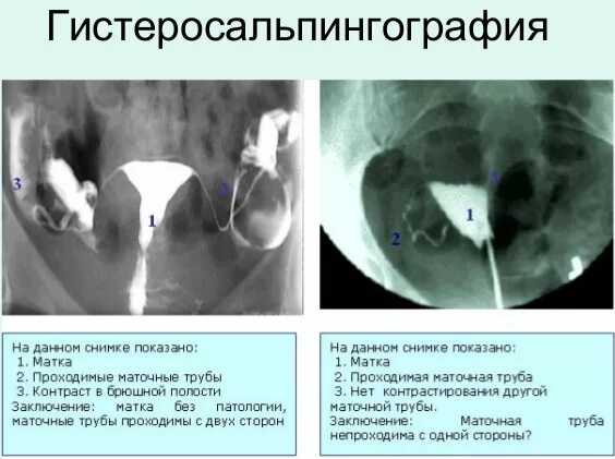 Рентген маточных труб фото Просвет маточной трубы