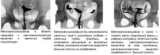 Рентген маточных труб фото Гистеросальпингография в диагностике бесплодия