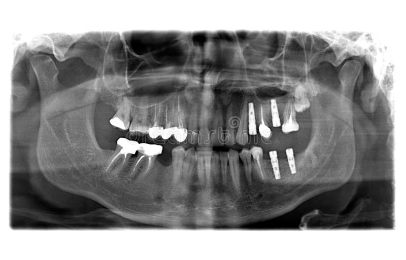 Рентген молочных зубов фото X ray of teeth stock image. Image of human, medicine - 141198959