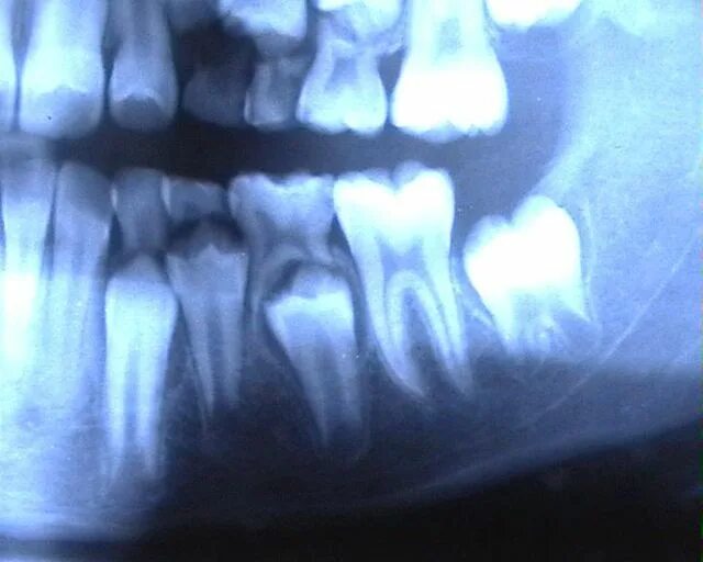 Рентген молочных зубов фото Dent déciduale - Wikipédia