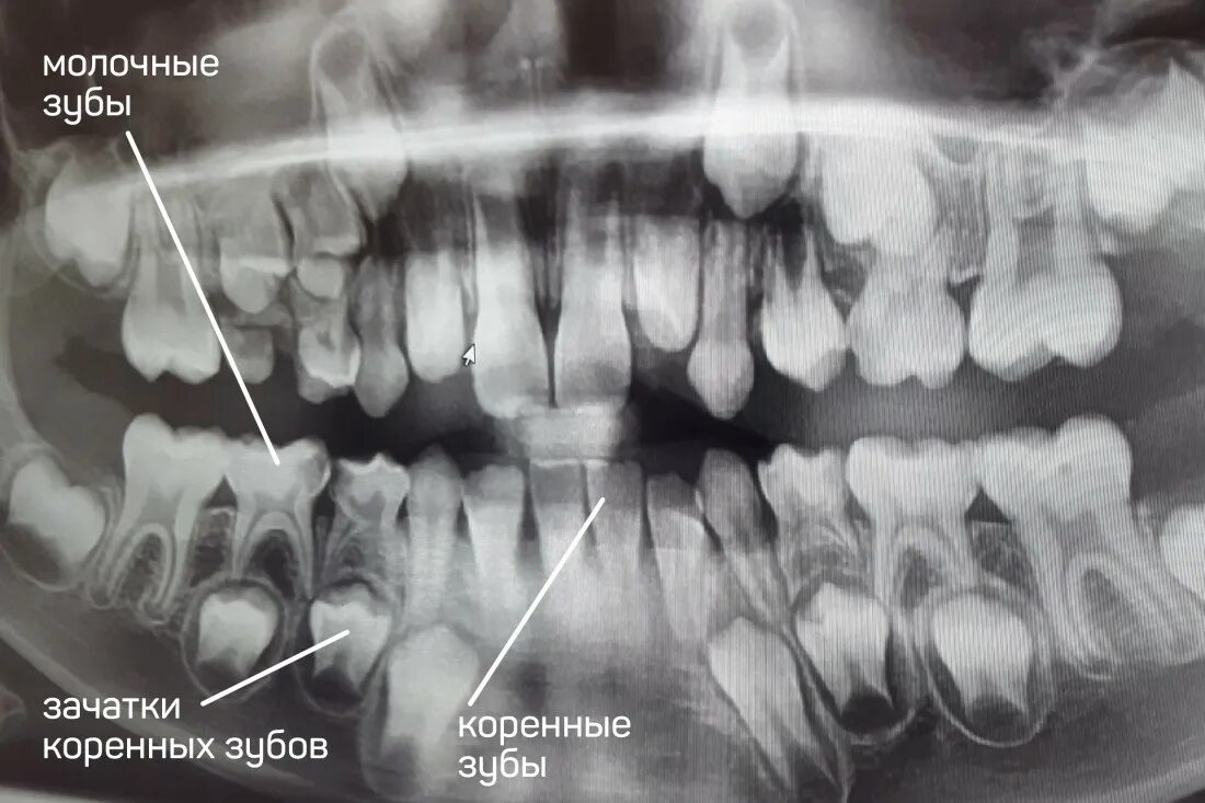 Рентген молочных зубов фото Свищ на десне - что это, как лечить взрослого, что делать, фото