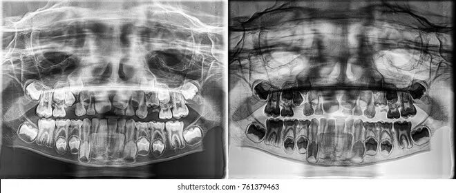 Рентген молочных зубов фото Deciduous Tooth X Ray: изображения, стоковые фотографии и векторная графика Shut