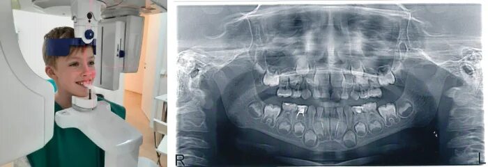 Рентген молочных зубов фото Панорамный снимок зубов (ортопантомограмма) в Москве - цены на ОПТГ в клинике Се