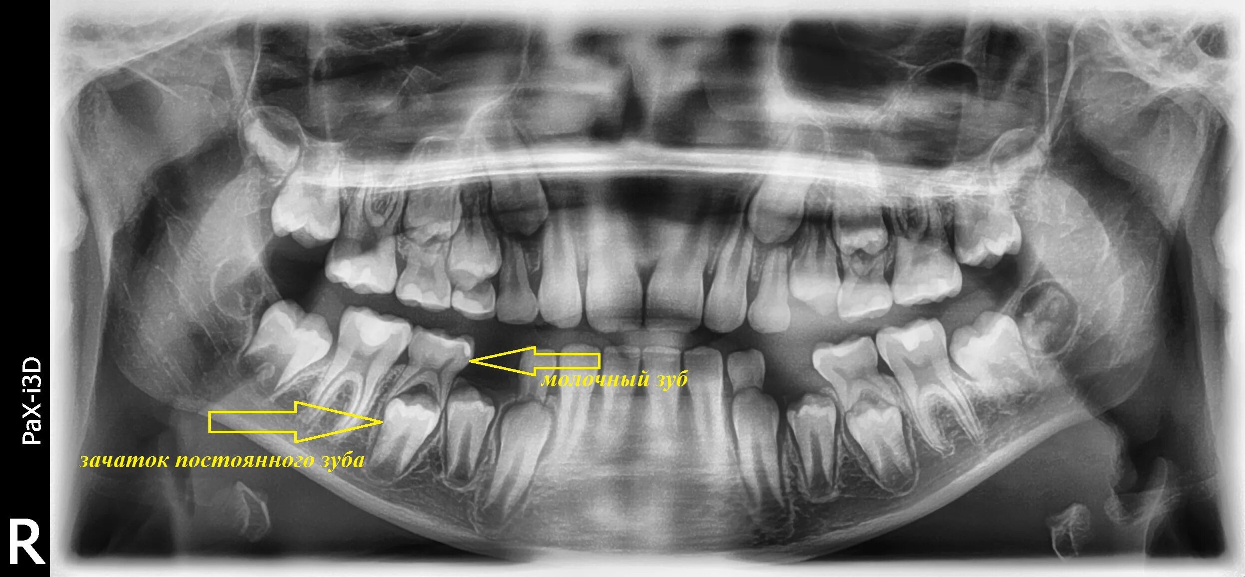 Plik:Deciduous teeth-boy-OPG-10,10,2019.jpg - Wikipedia, wolna encyklopedia