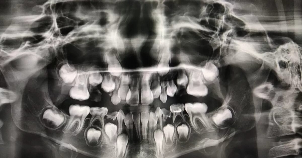 Рентген молочных зубов фото Рентген зубов ребенка Пикабу
