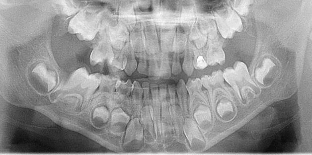 Рентген молочных зубов фото Сменный прикус - www.orthodont.am