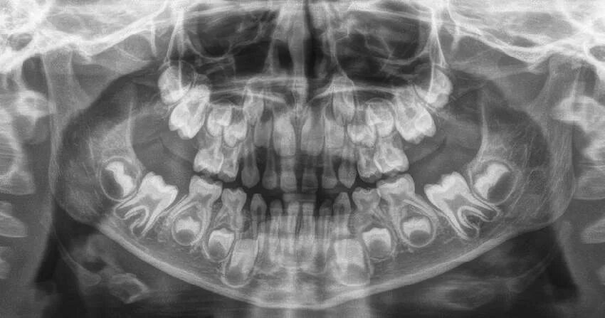 Рентген молочных зубов фото Зачатки зубов и этапы их формирования