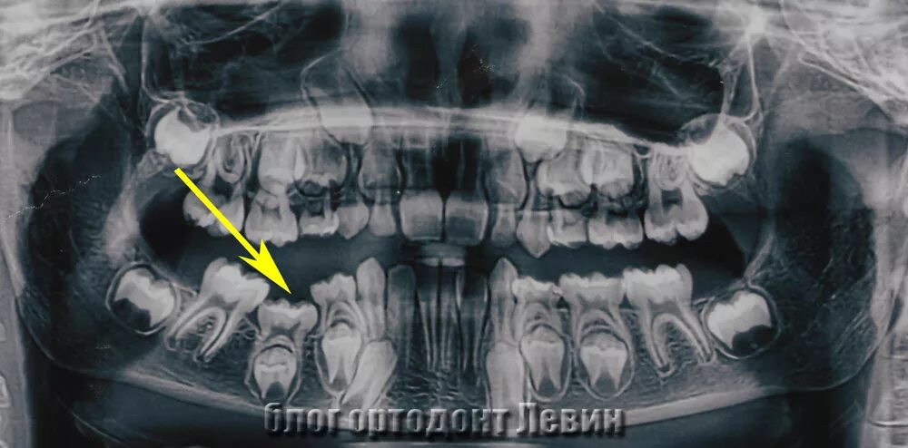 Рентген молочных зубов фото Зрительная ретенция - найдено 80 фото