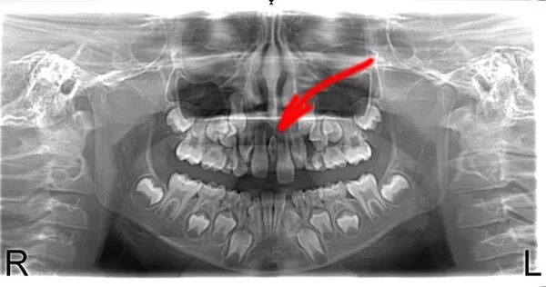 Рентген молочных зубов фото Ответы Mail.ru: Младенчику 13 лет. При осмотре стоматолог обнаружил несколько мо