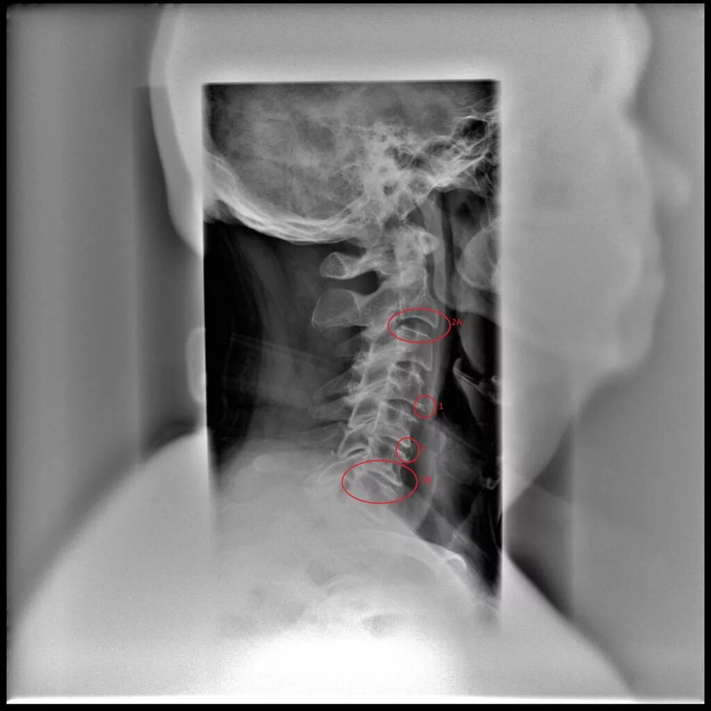 Рентген остеохондроза грудного отдела фото Йога при остеохондрозе шейного отдела позвоночника