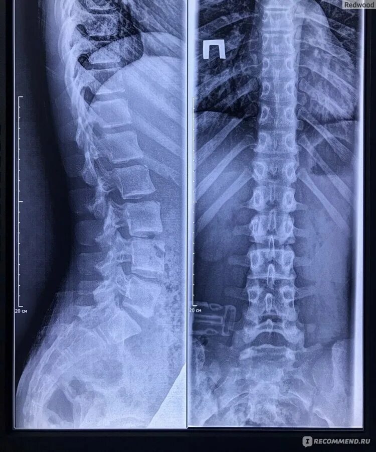 Pre-operative radiograph of lumbosacral spine anteroposterior and... Download Sc