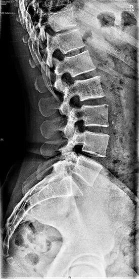Рентген пояснично крестцового отдела фото Рентген пояснично-крестцового отдела позвоночника в Москве сделать рентген поясн