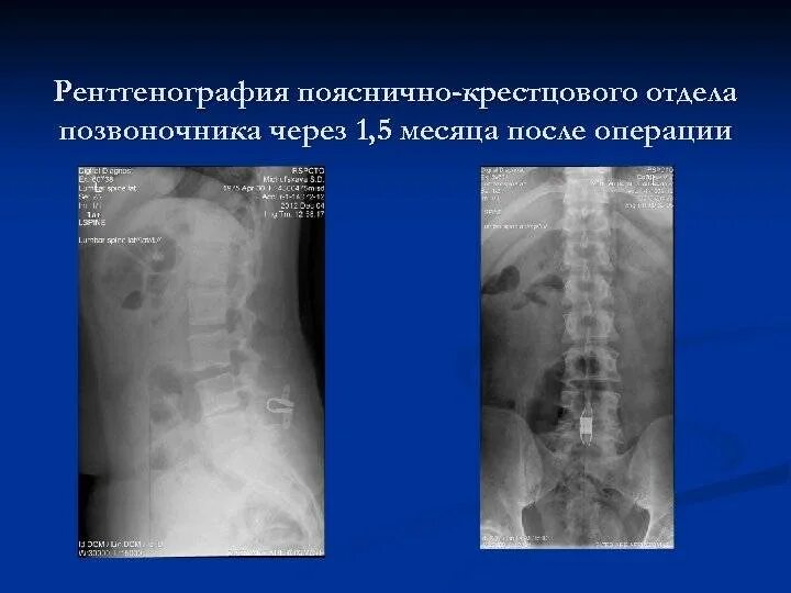 Рентген пояснично крестцового отдела фото Рентген хасавюрт: найдено 90 изображений