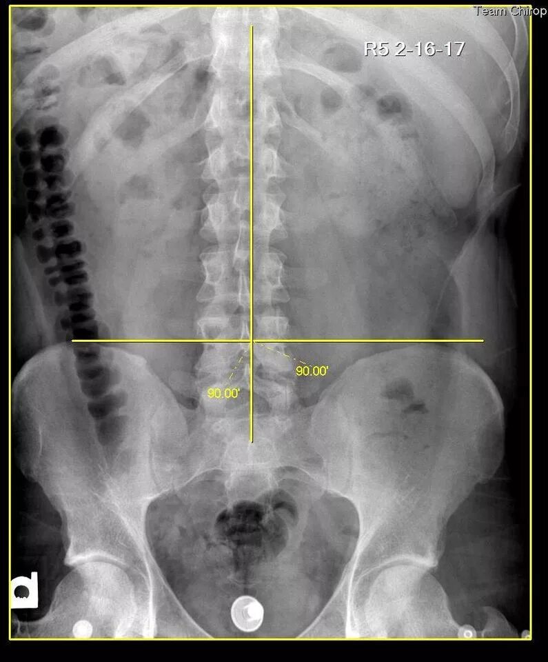 Рентген пояснично крестцового отдела фото Сделать рентген крестцового отдела