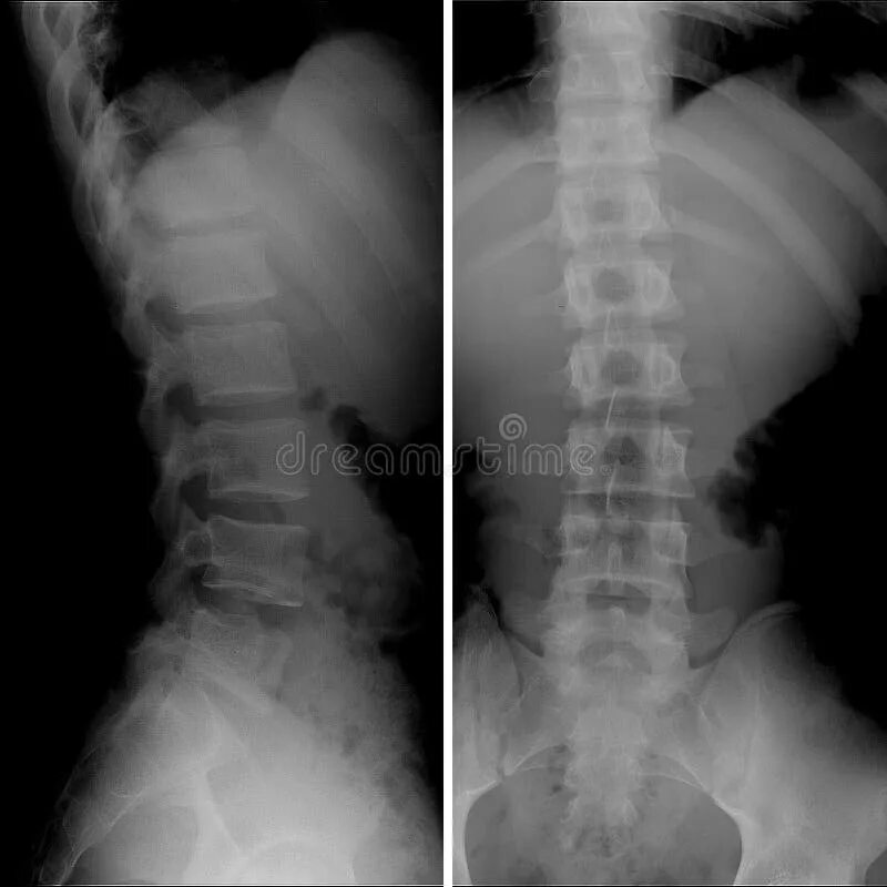 Рентген пояснично крестцового отдела позвоночника фото X-ray of Lumbosacral Spine, Frontal Sagital View Scoliosis Stock Image - Image o