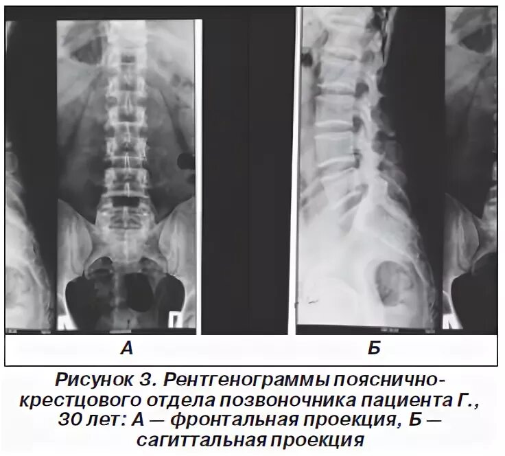 Рентген пояснично крестцового отдела позвоночника фото Синдром системного ограничения подвижности позвоночника у пациентов с дорсопатие