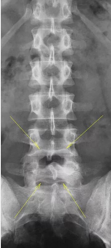 Рентген пояснично крестцового отдела позвоночника фото Рентгенография шейного и поясничного отдела позвоночника. Портал радиологов