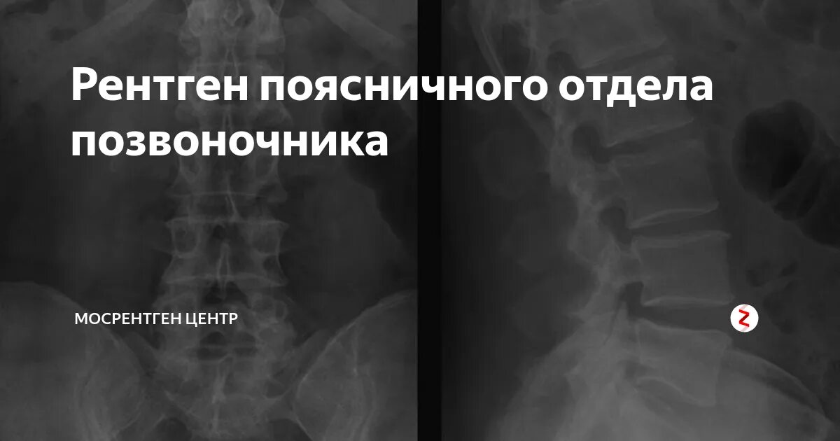 Рентген пояснично крестцового отдела позвоночника фото Функциональная рентгенография позвоночника