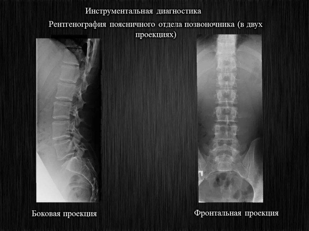 Рентген пояснично крестцового отдела позвоночника фото Рентгенография в двух проекциях позвоночника