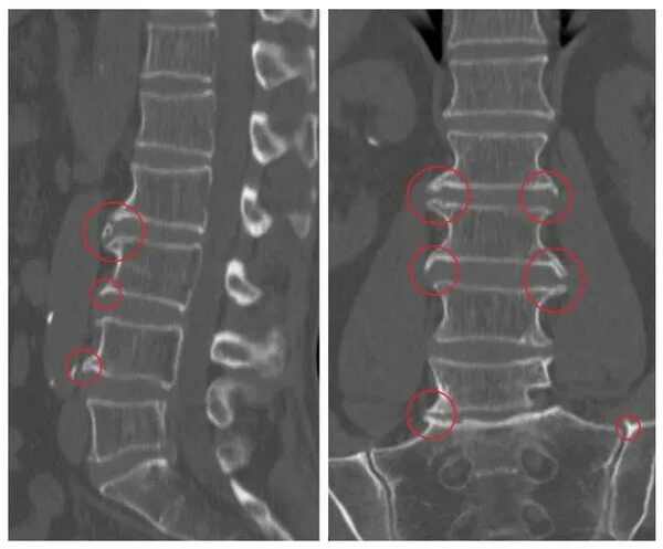 Рентген пояснично крестцового отдела позвоночника фото Спондилез поясничного отдела позвоночника: что это такое и лечение в статье невр