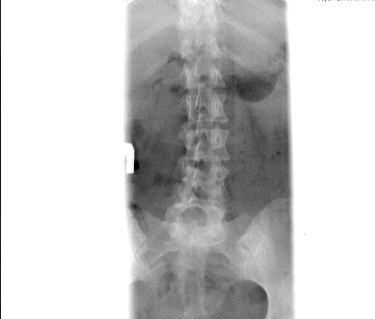 Pre-operative radiograph of lumbosacral spine anteroposterior and... Download Sc