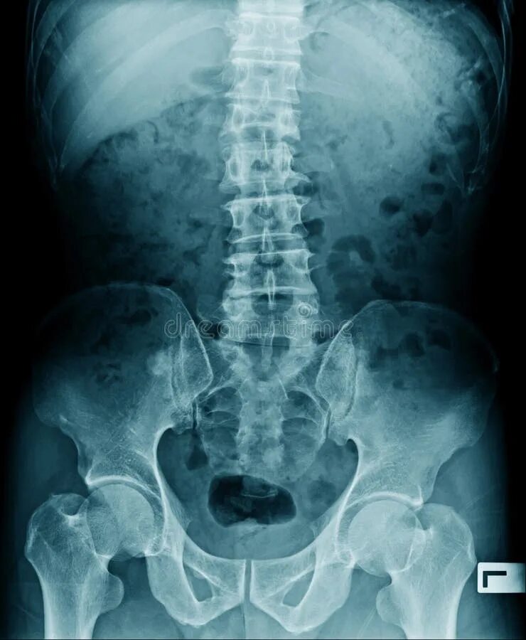 Рентген пояснично крестцового отдела позвоночника фото Xray Lumbar Spine Vertebrae Pathology with Hardware Stock Image - Image of fusio