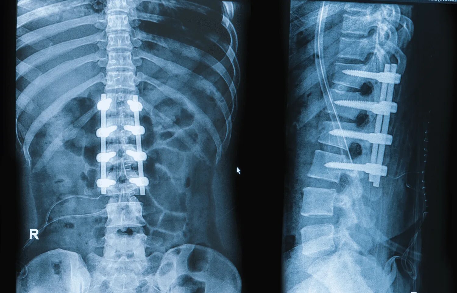 Рентген поясничного отдела фото Pseudoarthrosis in the Cervical and Lumbar Spine